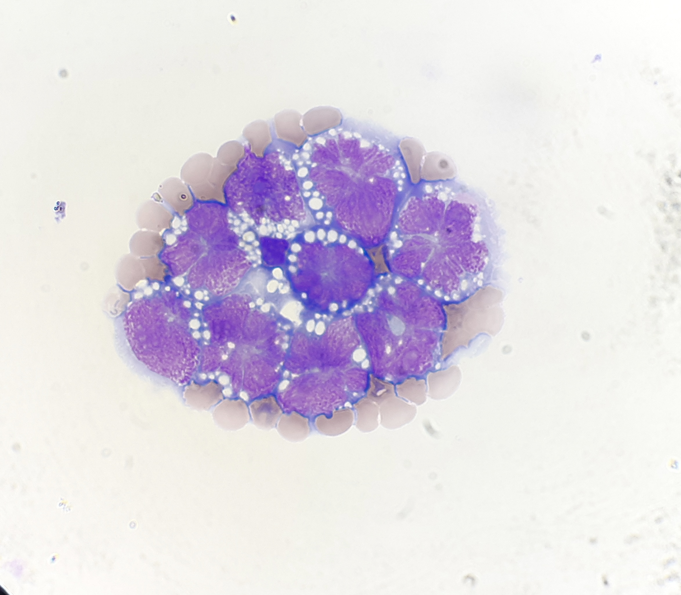 Linfoma não Hodgkin