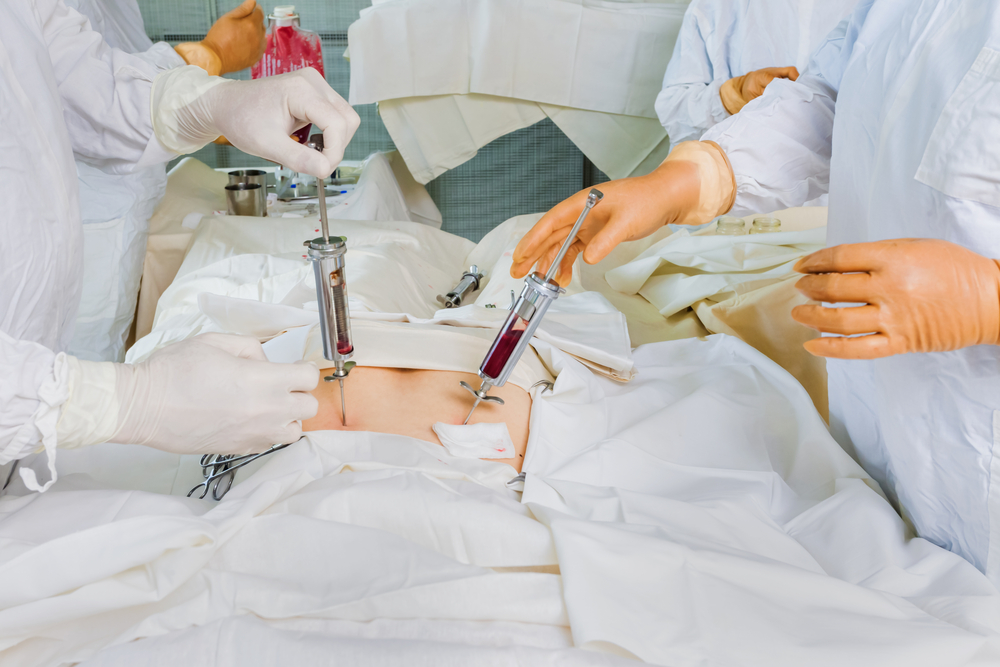 Complicações pós-transplante de medula óssea: tipos, fatores de risco e prevenção