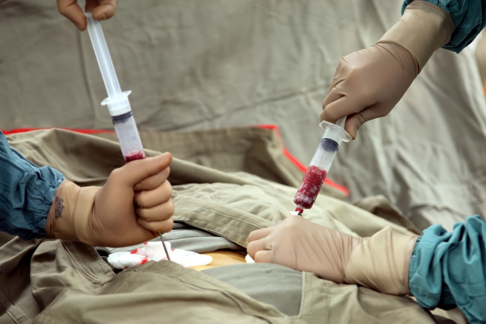 Fatores que influenciam no preço do transplante de medula óssea