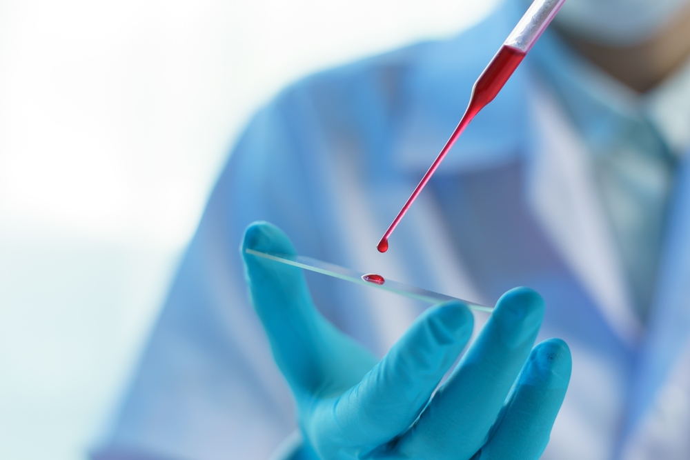Alterações no hemograma: saiba quais são e o que fazer