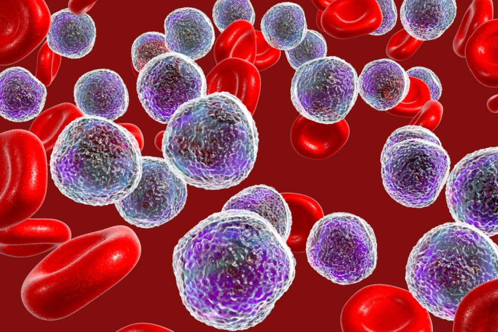 Tratamento da leucemia mieloide aguda: quais são as opções?