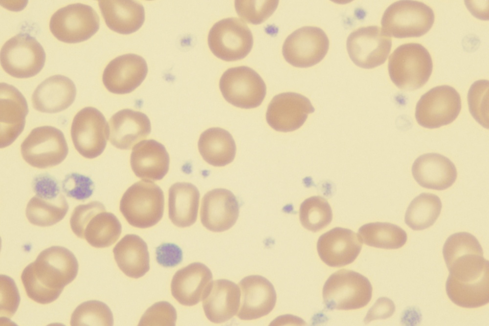 O que é a síndrome mieloproliferativa (SMP)?
