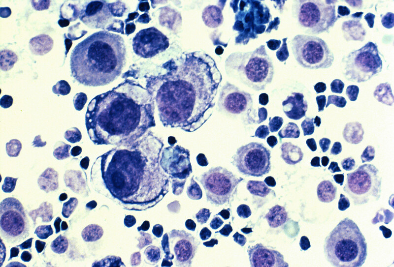 Linfoma de células B: o que é, tipos, diagnóstico e tratamentos